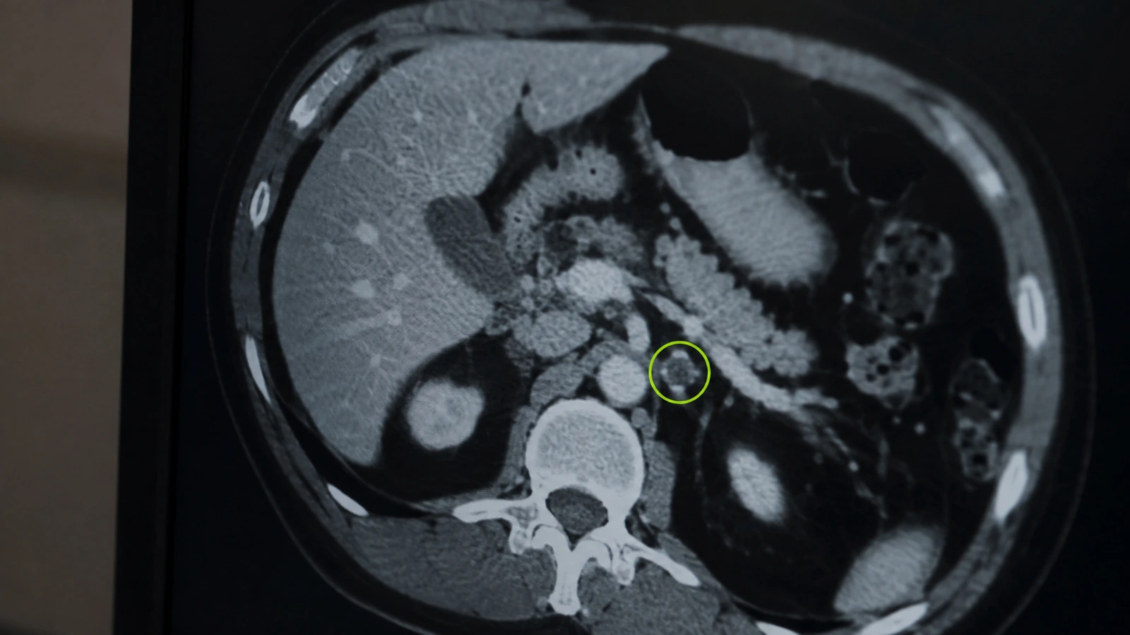 Close-up eines Monitors mit einem Schnittbild, auf dem KI in der Radiologie einen Rundherd lime umringt hat