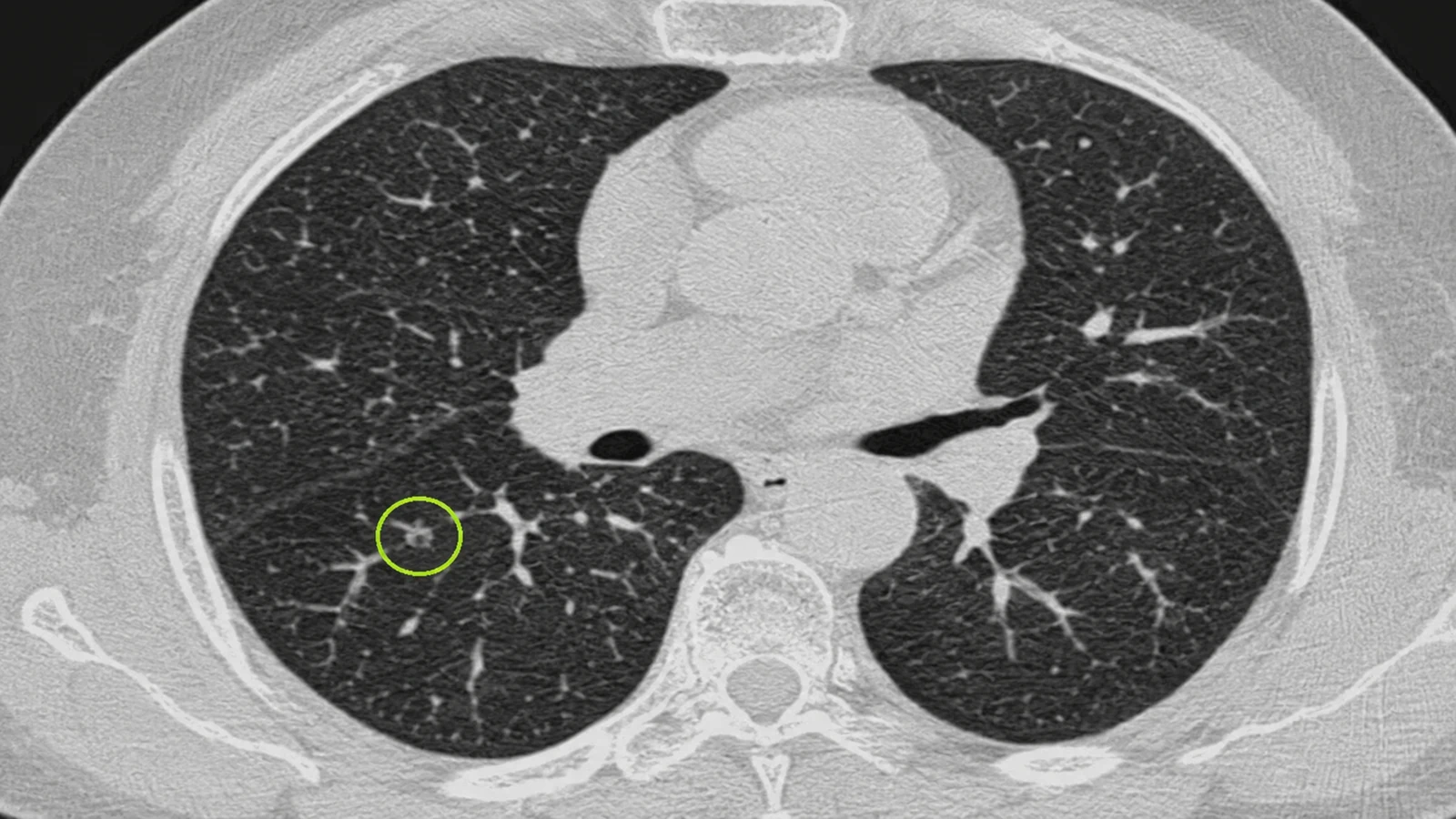 Close-up eines Monitors mit einem Lungen-CT-Schnitt, auf dem ein kleiner Fleck lime umringt hervorgehoben ist
